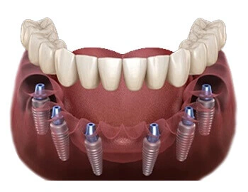 AV Dental Clinic Full Mouth Implants