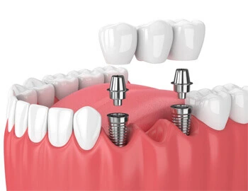 AV Dental Clinic Multiple Implants