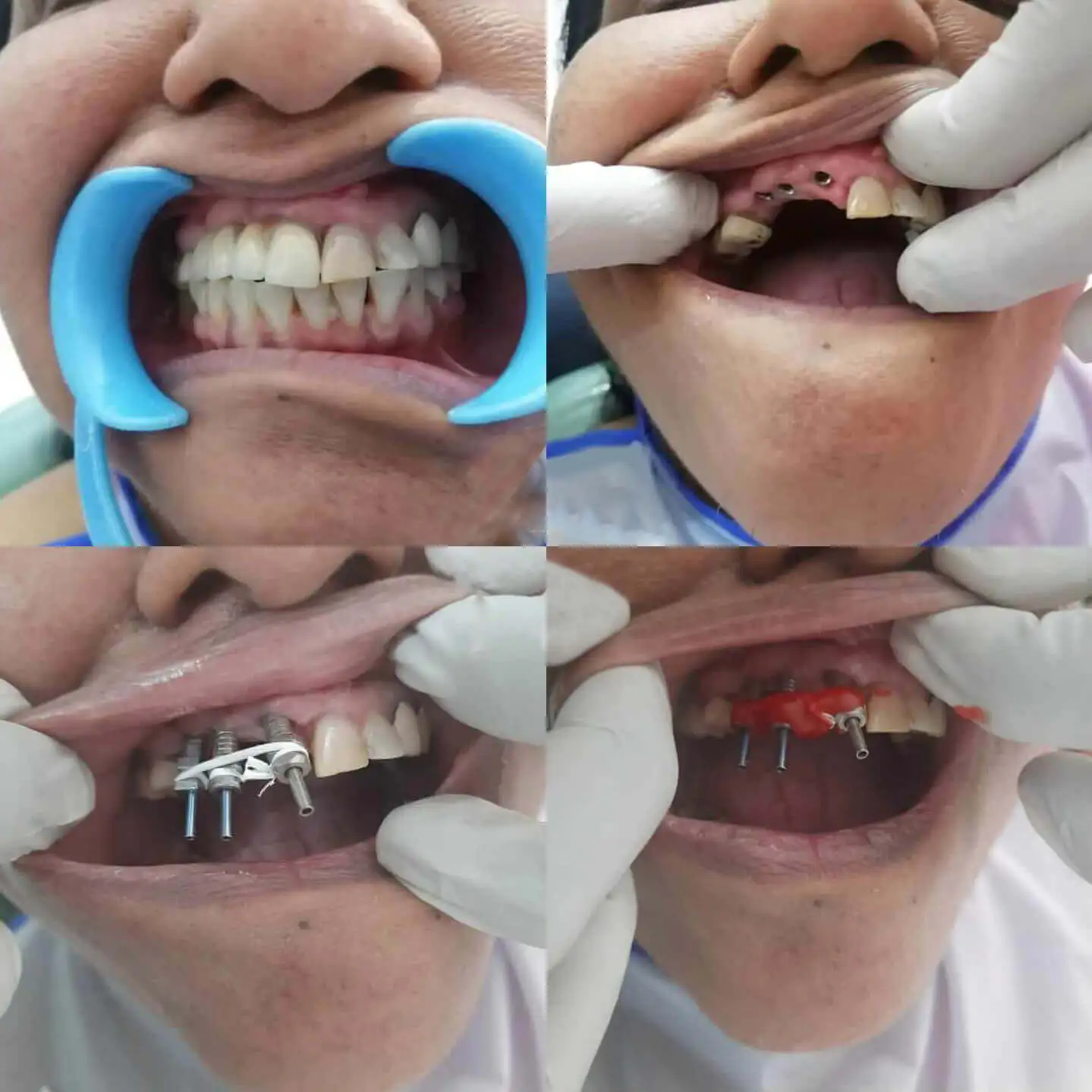 AV Dental Clinic Implant Supported Teeth