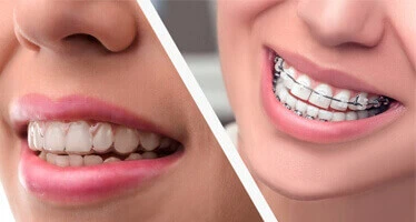 AV Dental Clinic Transparent Braces