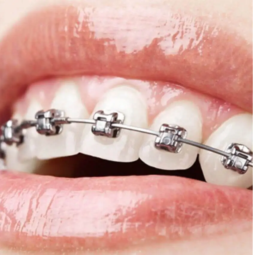 AV Dental Clinic Teeth Braces
